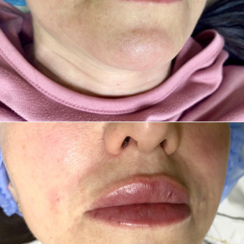 Контурная пластика губ
                    Дерматолог косметолог Алёна Николаев