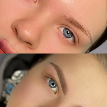 До процедуры и заживший результат ✅