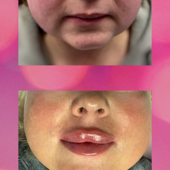 Губи, підборіддя, носогубні складки