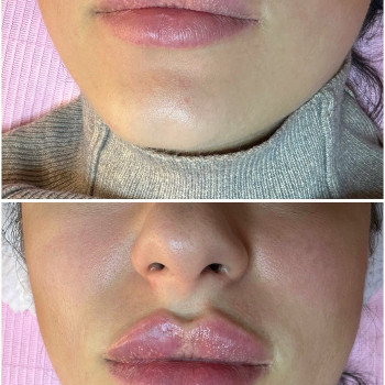 Губи у динаміці за 1,5 року. Без змін та міграцій препарату.