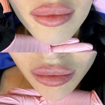 Корекція підборіддя філе ром