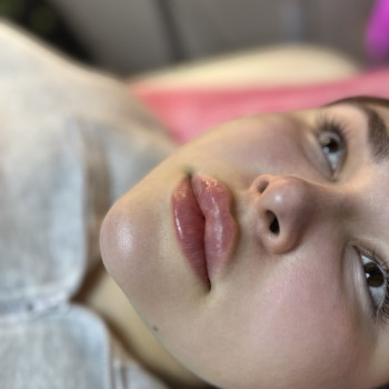 Підборіддя, губи другий мл , ліполітики підборіддя