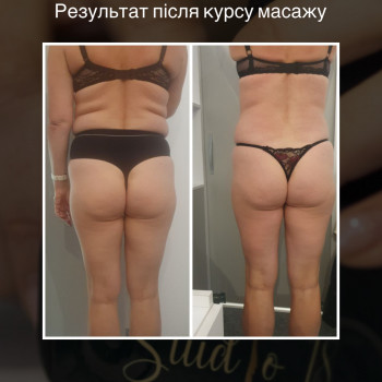 LPG масаж
                    Масажний салон  Тернопіль