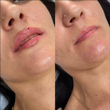 Губи, які хочеться цілувати!
                    Мастер лазерной эпиляции  Васильков