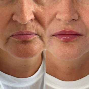 Губи, які хочеться цілувати!
                    Мастер лазерной эпиляции  Васильков