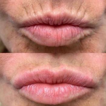 Губи, які хочеться цілувати!
                    Мастер лазерной эпиляции  Васильков