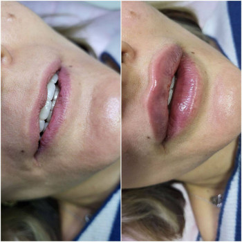 Губи, які хочеться цілувати!
                    Мастер лазерной эпиляции  Васильков