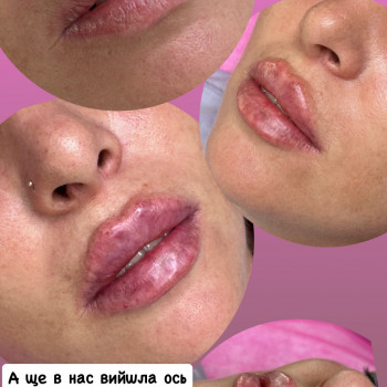 Губи, які хочеться цілувати!
                    Мастер лазерной эпиляции  Васильков