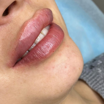 Губи, які хочеться цілувати!
                    Мастер лазерной эпиляции  Васильков