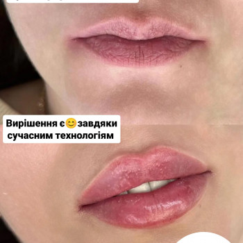 Губи, які хочеться цілувати!
                    Мастер лазерной эпиляции  Васильков