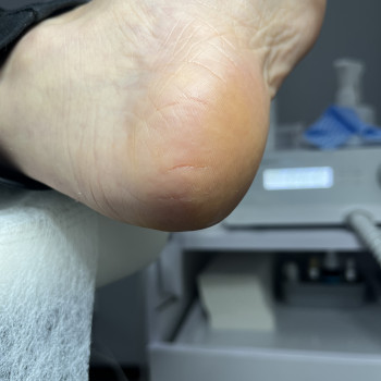 Обробка тріщин поверхневих 2 стопи
                    Подолог Дарья Киев