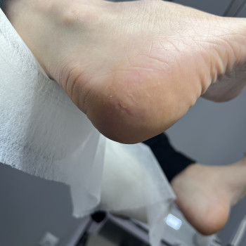 Обробка тріщин поверхневих 2 стопи
                    Подолог Дарья Киев