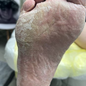 Лікування грибкового ураження
                    Преподаватель курсов красоты Екатерина Запорожье