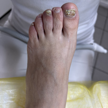 Лікування грибкового ураження
                    Преподаватель курсов красоты Екатерина Запорожье