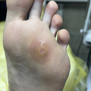 Видалення мозолів
                    Преподаватель курсов красоты Екатерина Запорожье