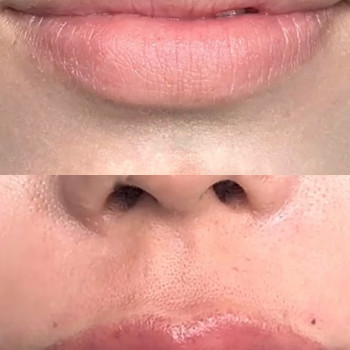 Виправлення асиметрії губ