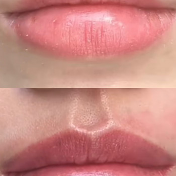 Виправлення асиметрії губ