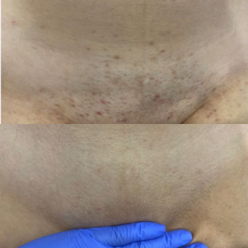 лазерна епіляція бікіні 