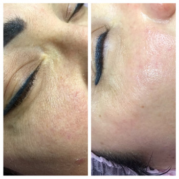 Фракційна мезотерапія
                    Лешмейкер Алена Киев