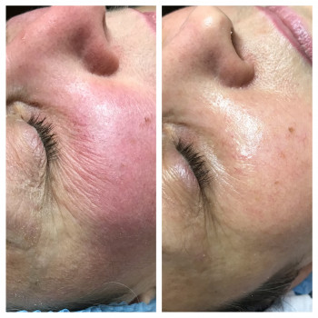 Фракційна мезотерапія
                    Лешмейкер Алена Киев