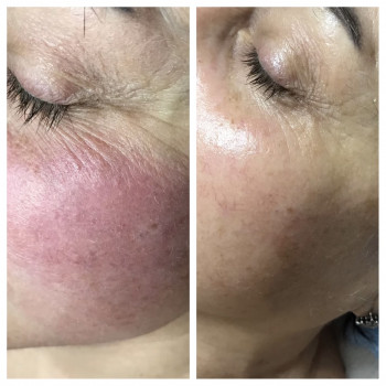 Фракційна мезотерапія
                    Лешмейкер Алена Киев