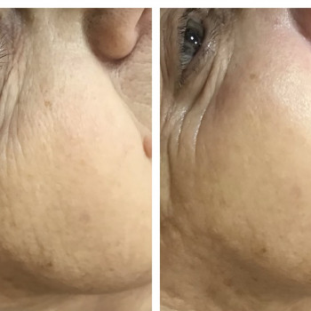 Фракційна мезотерапія
                    Лешмейкер Алена Киев