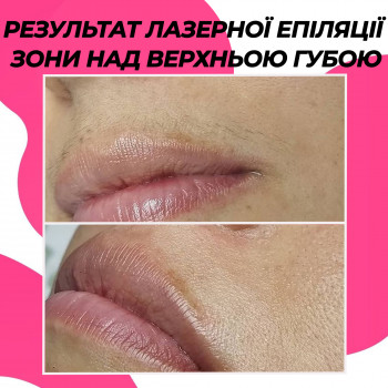 Лазерна епіляція обличчя повністю
                    Салон красоты Мастерская Красоты "Юлии Юдиной" Киев