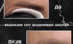 Видалення тату/татуажу Тату салон Fusion Киев