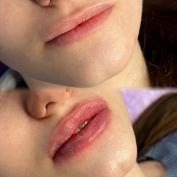 Доведення залишком 0,5 ml Revolax deep