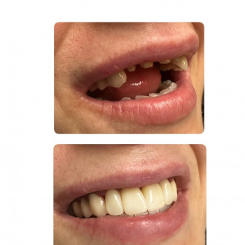 Цирконієві коронки