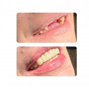 Металокерамічні коронки