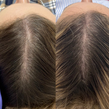 Мезотерапія голови (Hair loss control) Іспанія
                    Косметолог Людмила Киев