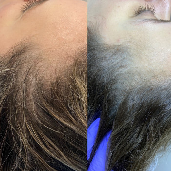 Мезотерапія голови (Hair loss control) Іспанія
                    Косметолог Людмила Киев