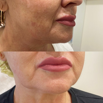 Контурна пластика обличчя
                    Косметолог Людмила Київ