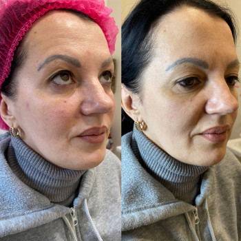 Контурна пластика обличчя
                    Косметолог Людмила Київ