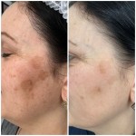 IPL Lumecca лікування пігментації/розацеа/судин Косметологический центр Beautymed Clinic Запорожье