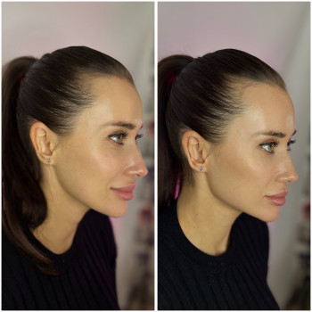 Full face Вилиці, кути Джолі, підборіддя
                    Косметолог-инъекционист Ірина Львов