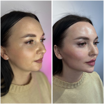 Full face Вилиці, кути Джолі, підборіддя
                    Косметолог-инъекционист Ірина Львов