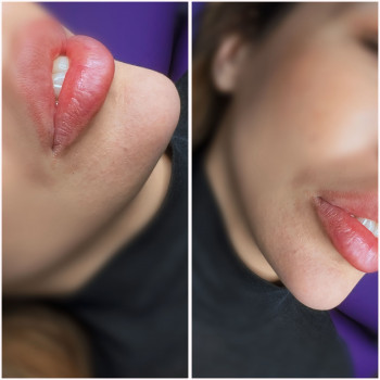 Full face Вилиці, кути Джолі, підборіддя
                    Косметолог-инъекционист Ірина Львов