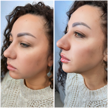 Full face Вилиці, кути Джолі, підборіддя
                    Косметолог-инъекционист Ірина Львов