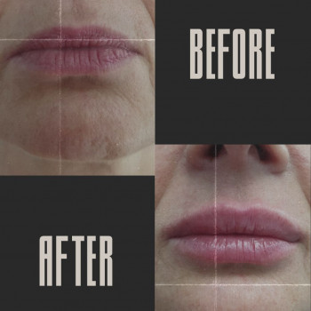 Контурна пластика губ
                    Косметологический центр  Ужгород