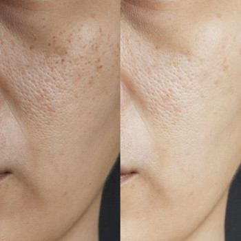 Механічна чистка
                    Косметологический центр  Ужгород