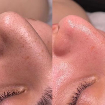 Механічна чистка
                    Косметологический центр  Ужгород