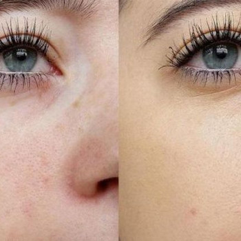 Механічна чистка
                    Косметологический центр  Ужгород