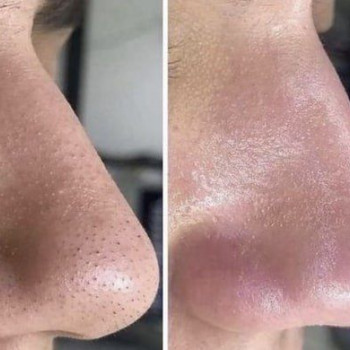 Механічна чистка
                    Косметологический центр  Ужгород