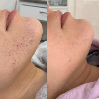 Механічна чистка
                    Косметологический центр  Ужгород