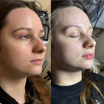 Збільшення губ