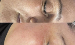 Мікроголковий RF ліфтинг Косметологічний центр O.L.Beauty Київ