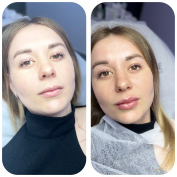 Контурна пластика губ