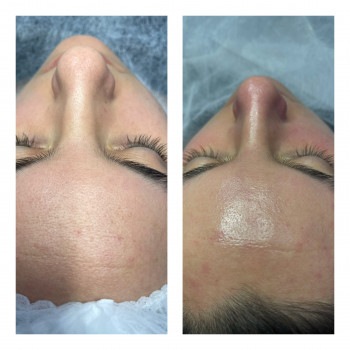 Чистка обличчя